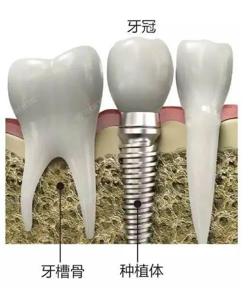 2024中国种植牙行业市场深度分析及未来发展趋势预测_人保财险政银保 ,人保服务