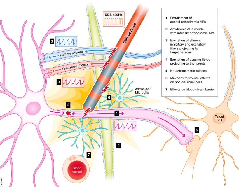 中国团队领衔研究：靶向新发现的大脑网络或改善帕金森病治疗